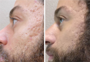 Hydrodermabrasion therapy for acne scarring