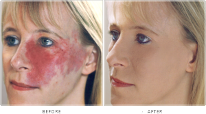 Facial Scars – Scar Makeup to Cover Scars