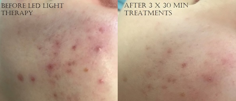 Acne Before and After LED Light Treatment
