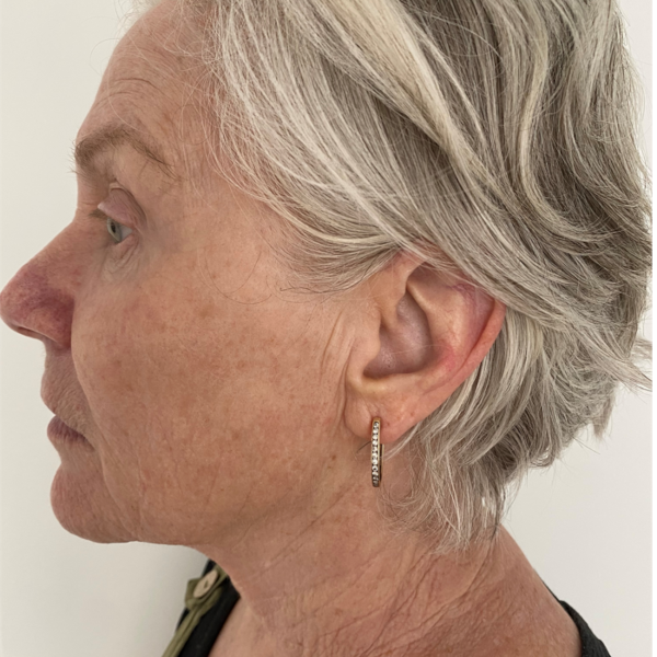 After HIFU treatment and Microneedling