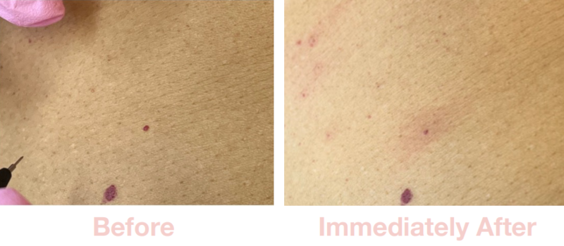 Blood Spots | Before & After Electrolysis