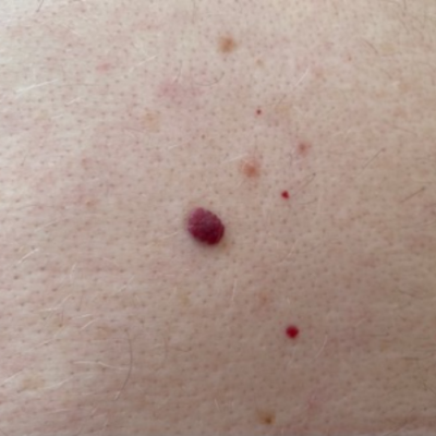 Campbell de Morgan Blood Spot | Electrolysis Skin Blemish Removal