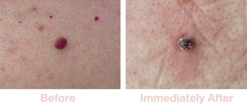 Campbell de Morgan Blood Spots | Before & After Electrolysis