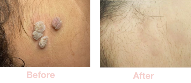 Filiform Wart | Before & After Electrolysis