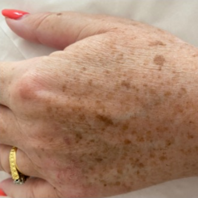 Pigmentation | Reduce the Appearance with Electrolysis