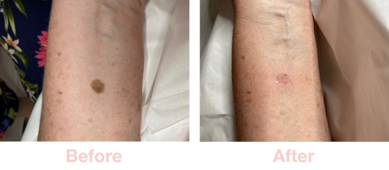 Pigmentation | Before & After Electrolysis Skin Blemish Removal