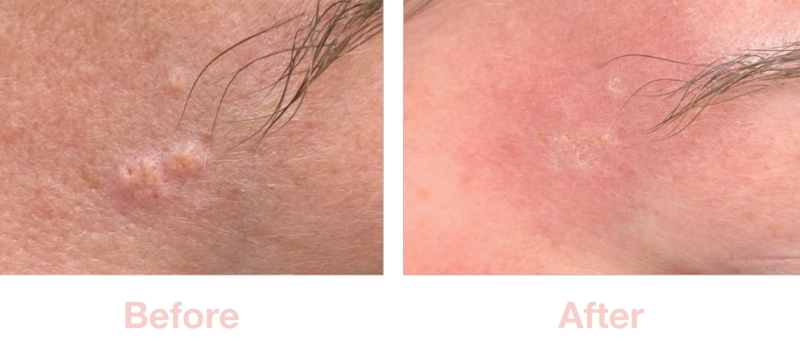 Sebaceous Hyperplasia | Before & After Electrolysis