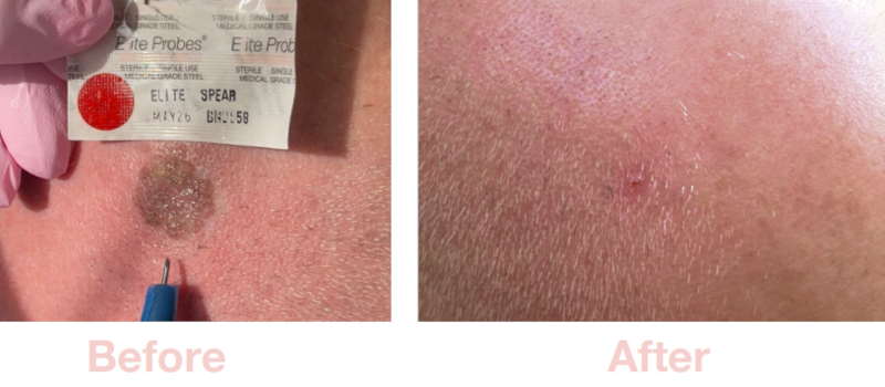 Seborrhoeic Keratosis | Before & After Electrolysis