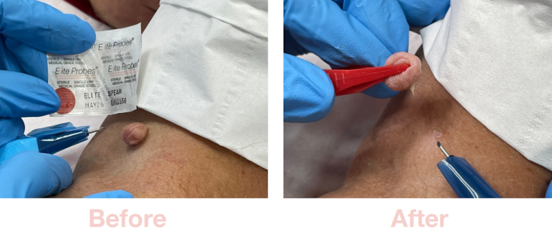 Skin Tags | Before & After with Advanced Electrolysis
