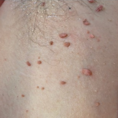 Skin Tags | Quickly Removed with Electrolysis