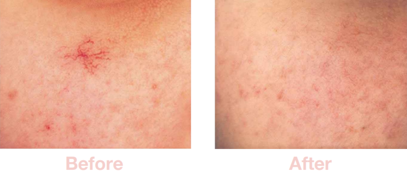 Spider Naevi (Spider Veins) | Before & After Electrolysis