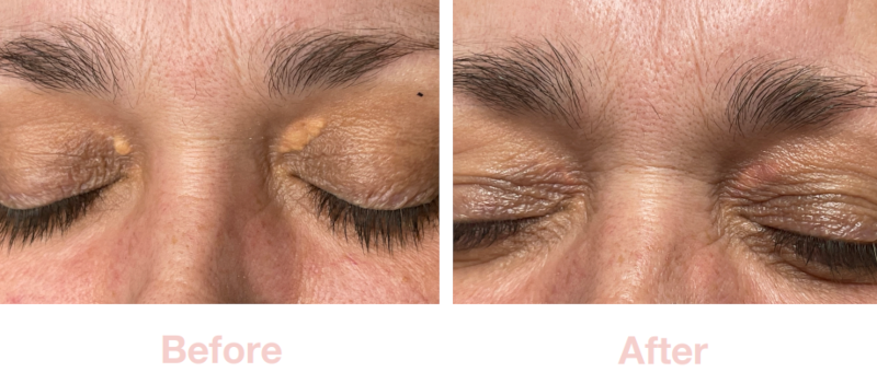 Xanthelasma (cholesterol spots) | Before & After Electrolysis