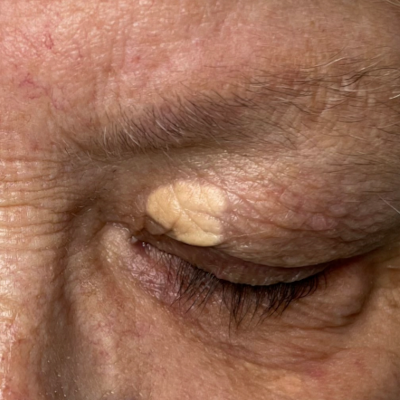 Xanthelasma | Remove Using Electrolysis